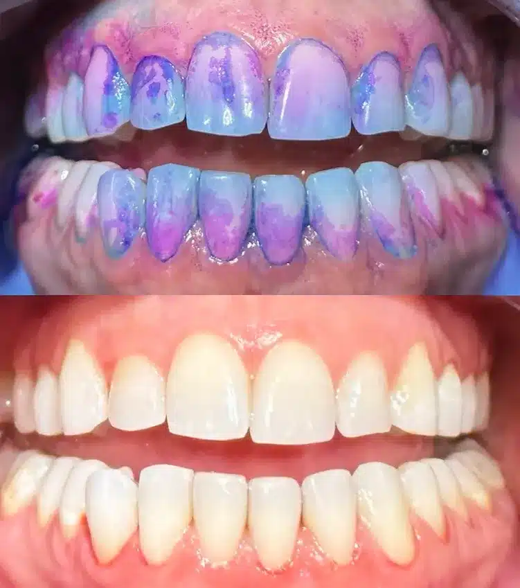 Before and After Deep Teeth Cleaning