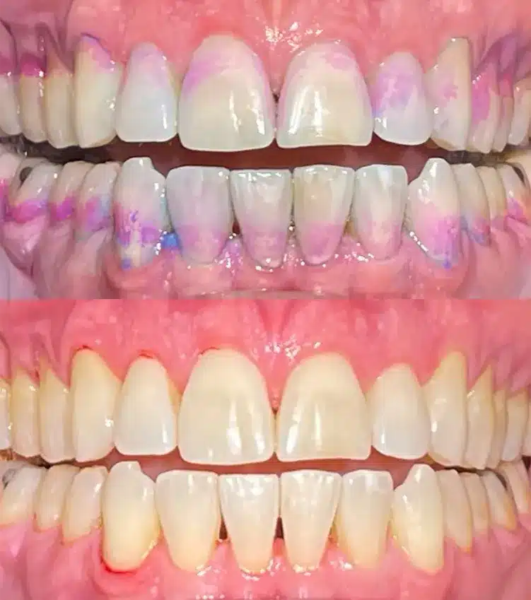 Before and After Teeth Cleaning 