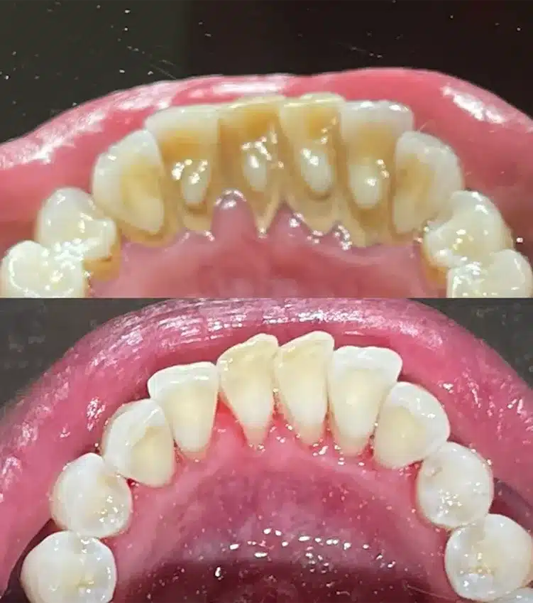 Before and After Teeth Cleaning in Calgary